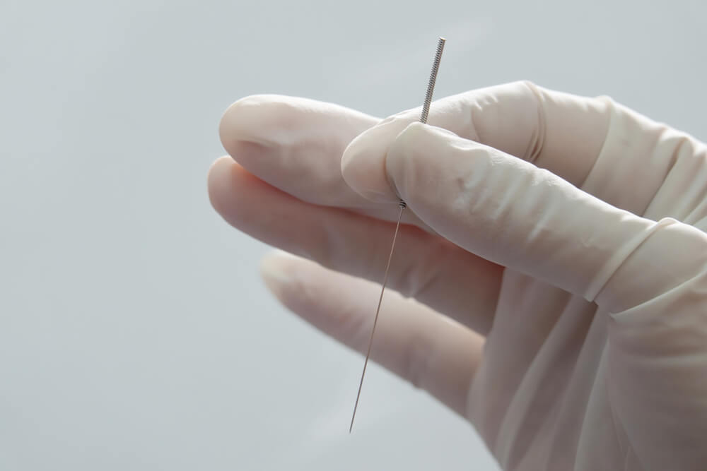 Dry Needling: The Unsung Hero of Pain Management